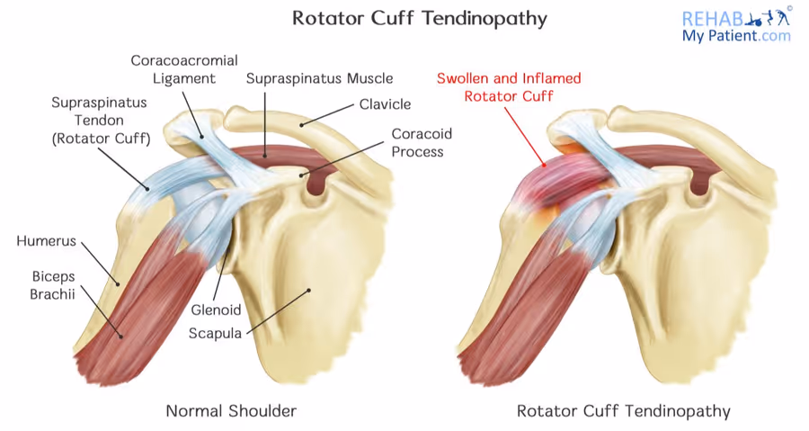 rotator_cuff_tendinopathy