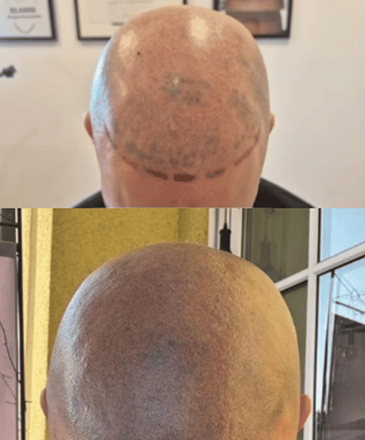 Haarpigmentierung – Vorher-Nachher Beispiel 3