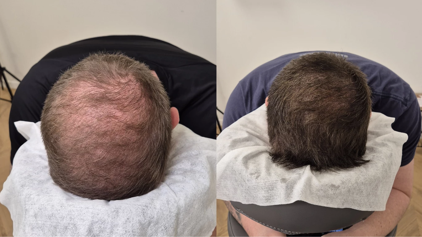 Haarpigmentierung – Vorher-Nachher Beispiel 4