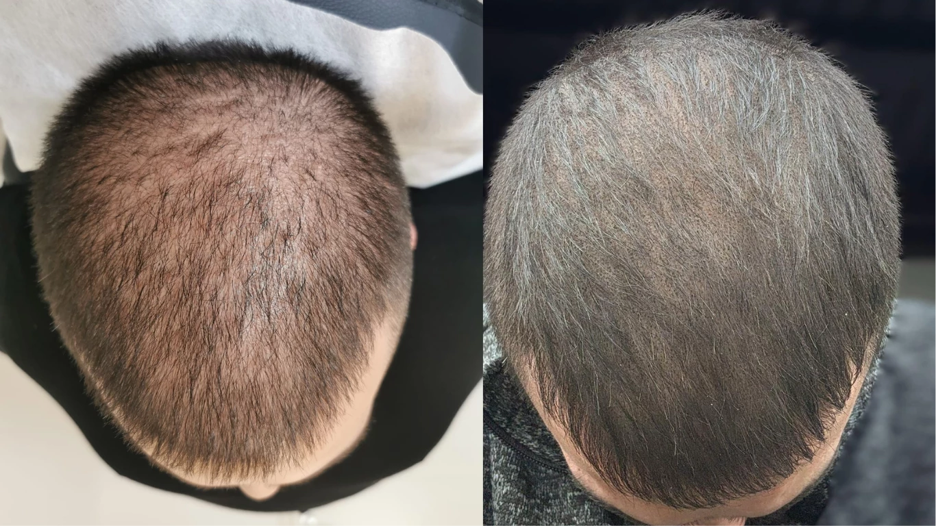 Haarpigmentierung – Vorher-Nachher Beispiel 6