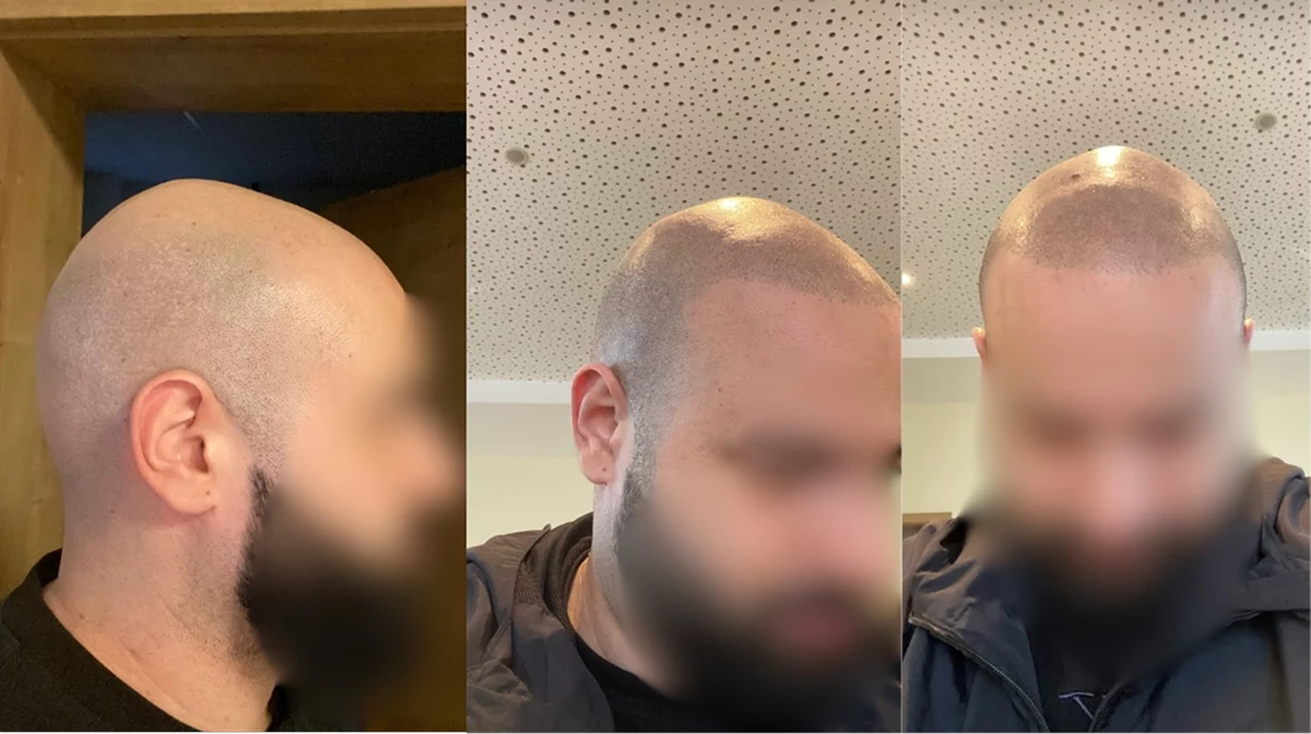 Haarpigmentierung – Vorher-Nachher Beispiel 1