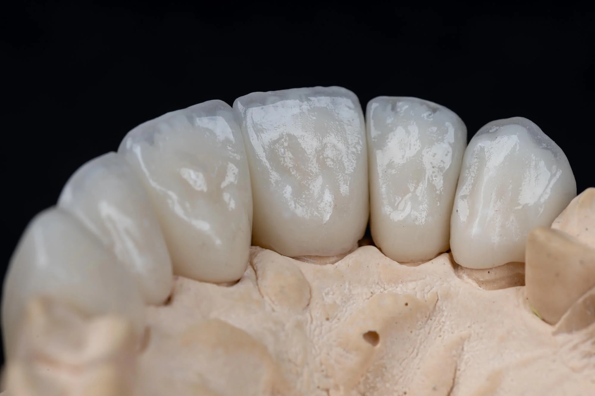 Custom dental crowns in Prattville