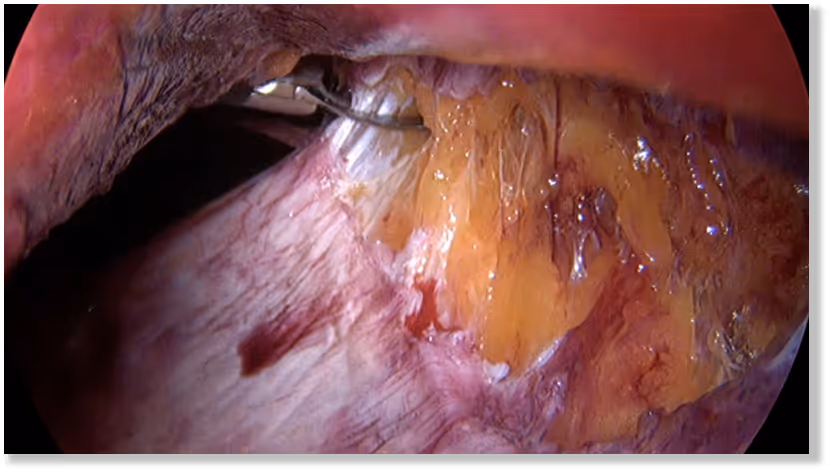 laparoskopowa operacja przepukliny brzusznej