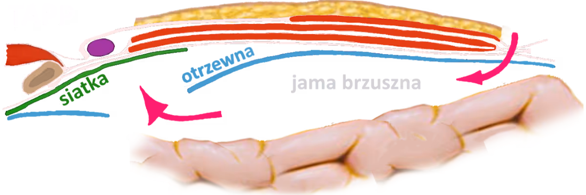 laparoskopia przepuklina pachwinowa TAPP