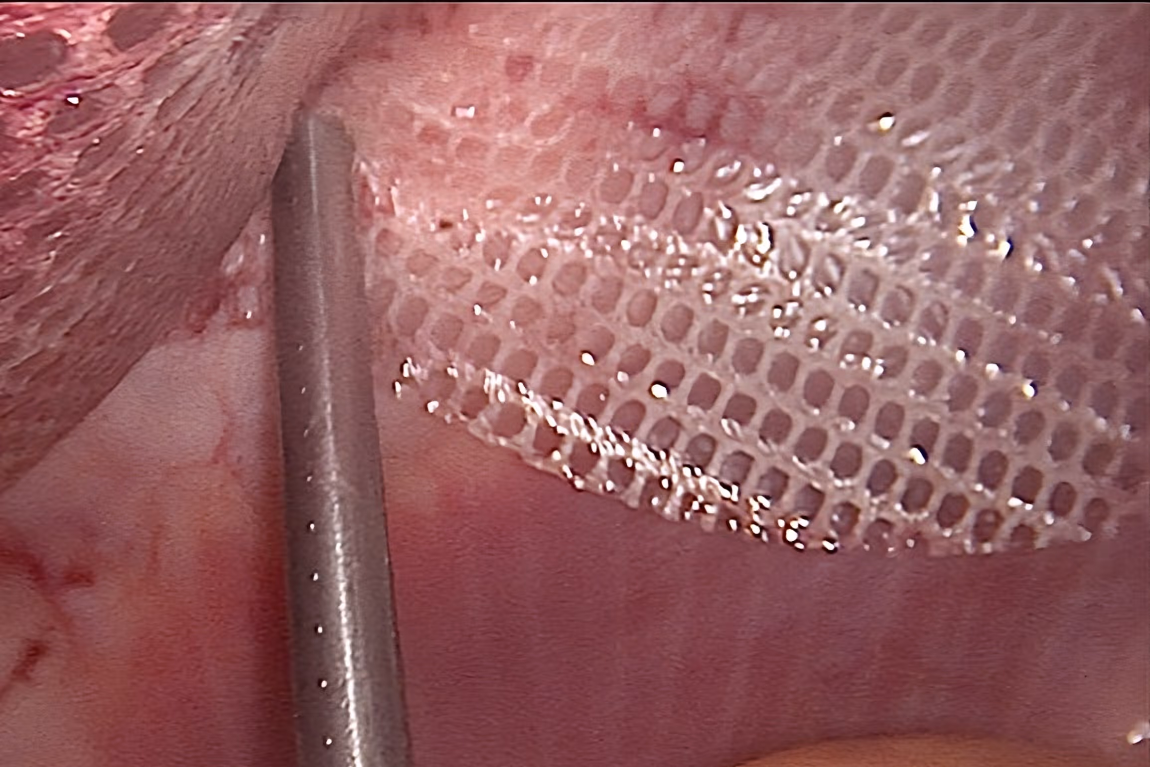 laparoskopowa operacja przepukliny siatka