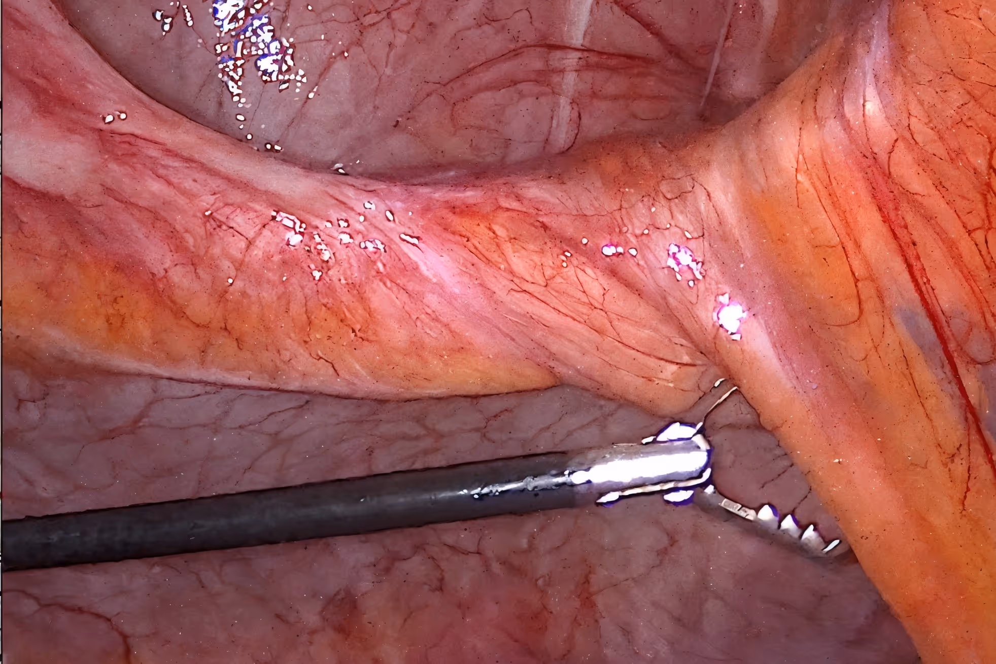 laparoskopowa operacja przepukliny