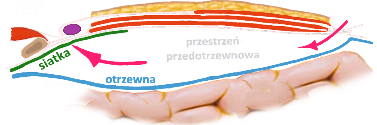 laparoskopia przepuklina pachwinowa TEP