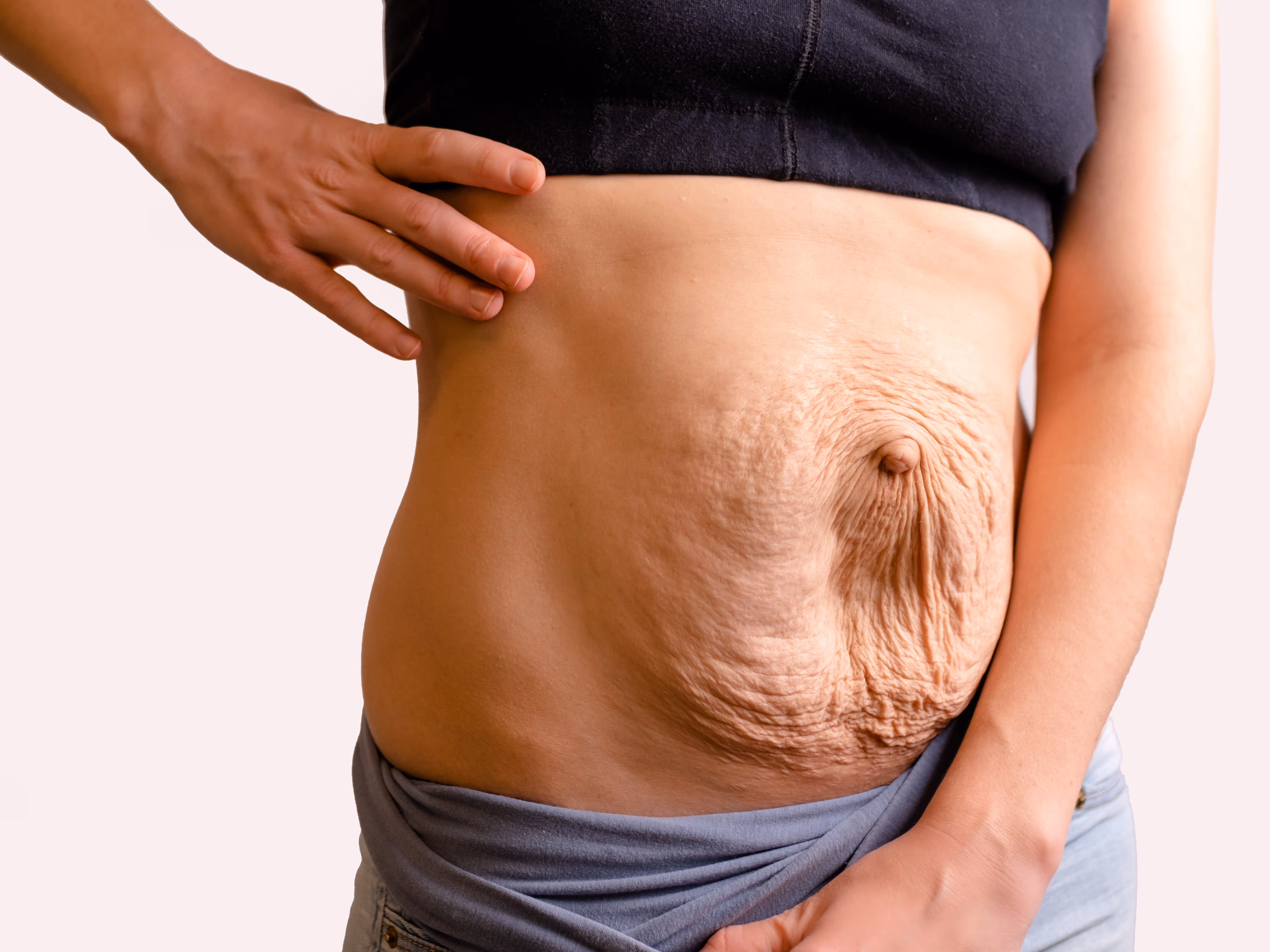 ppawi poporodowa niewydolność powłok brzucha