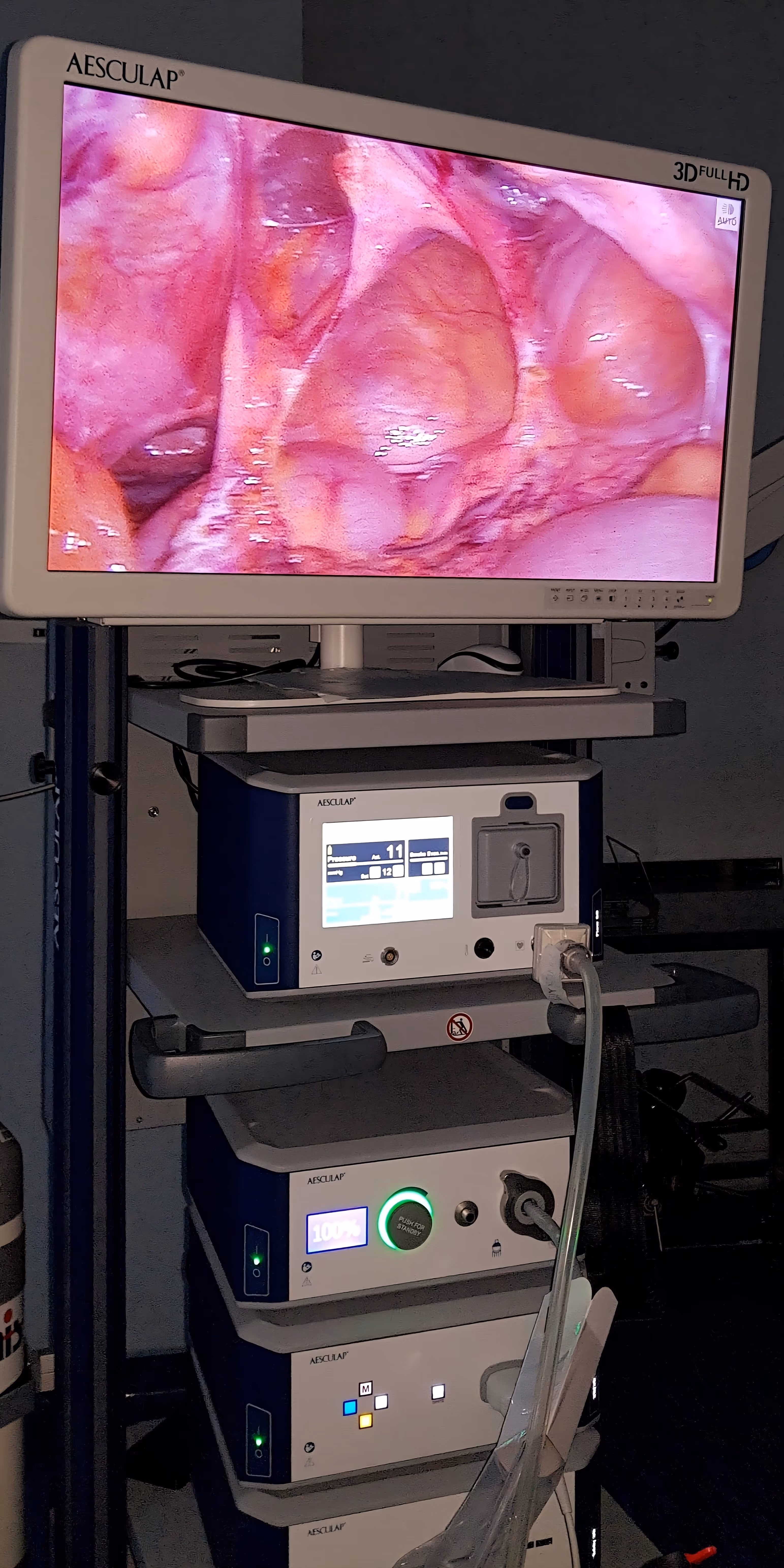 kolumna laparoskopowa operacja przepukliny