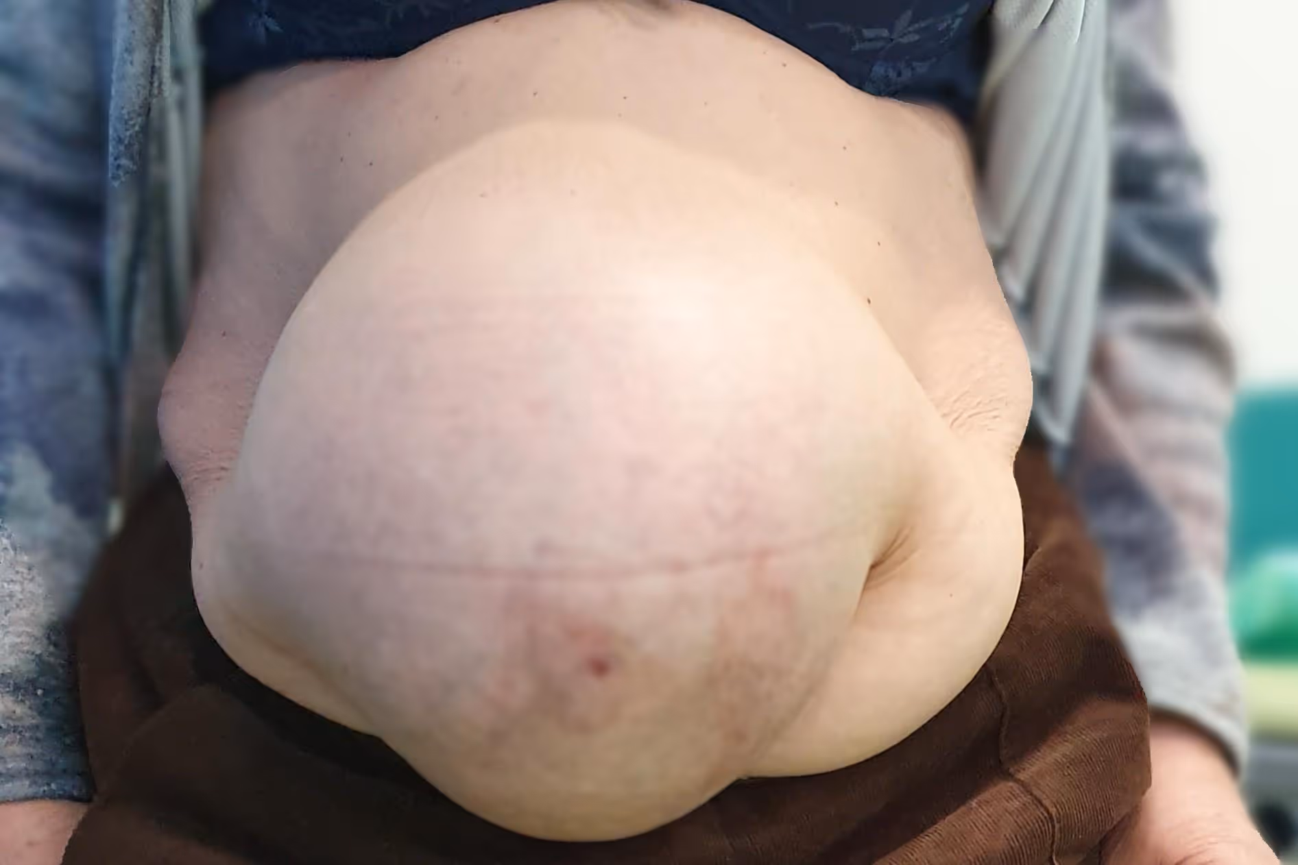 przepuklina brzuszna olbrzymia