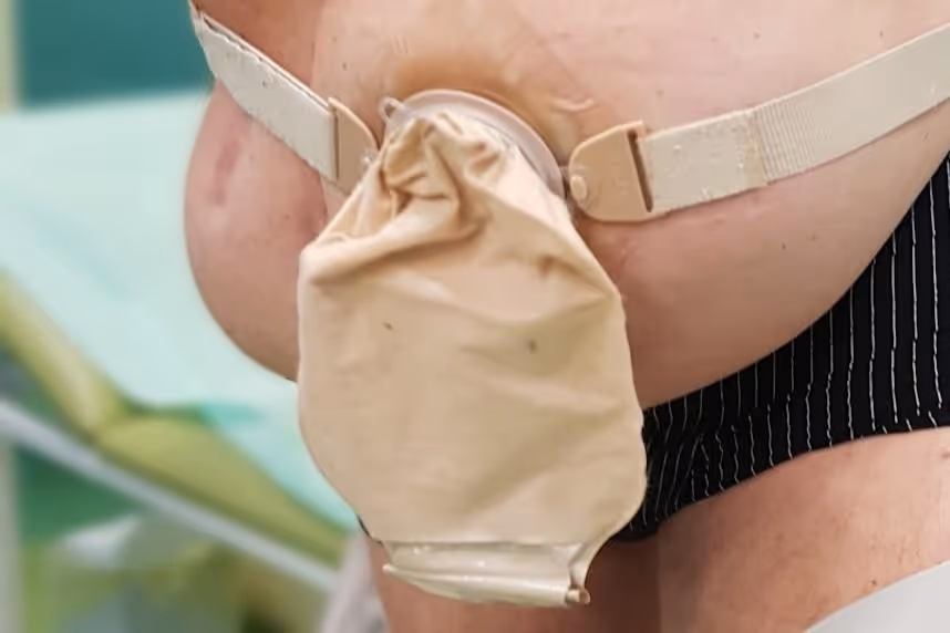 przepuklina okolostomijna