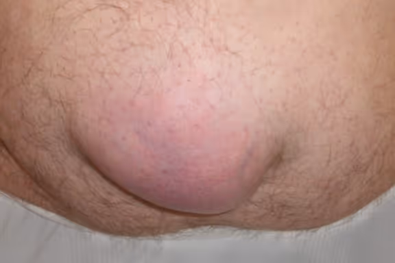 przepuklina pępkowa uwięźnięta