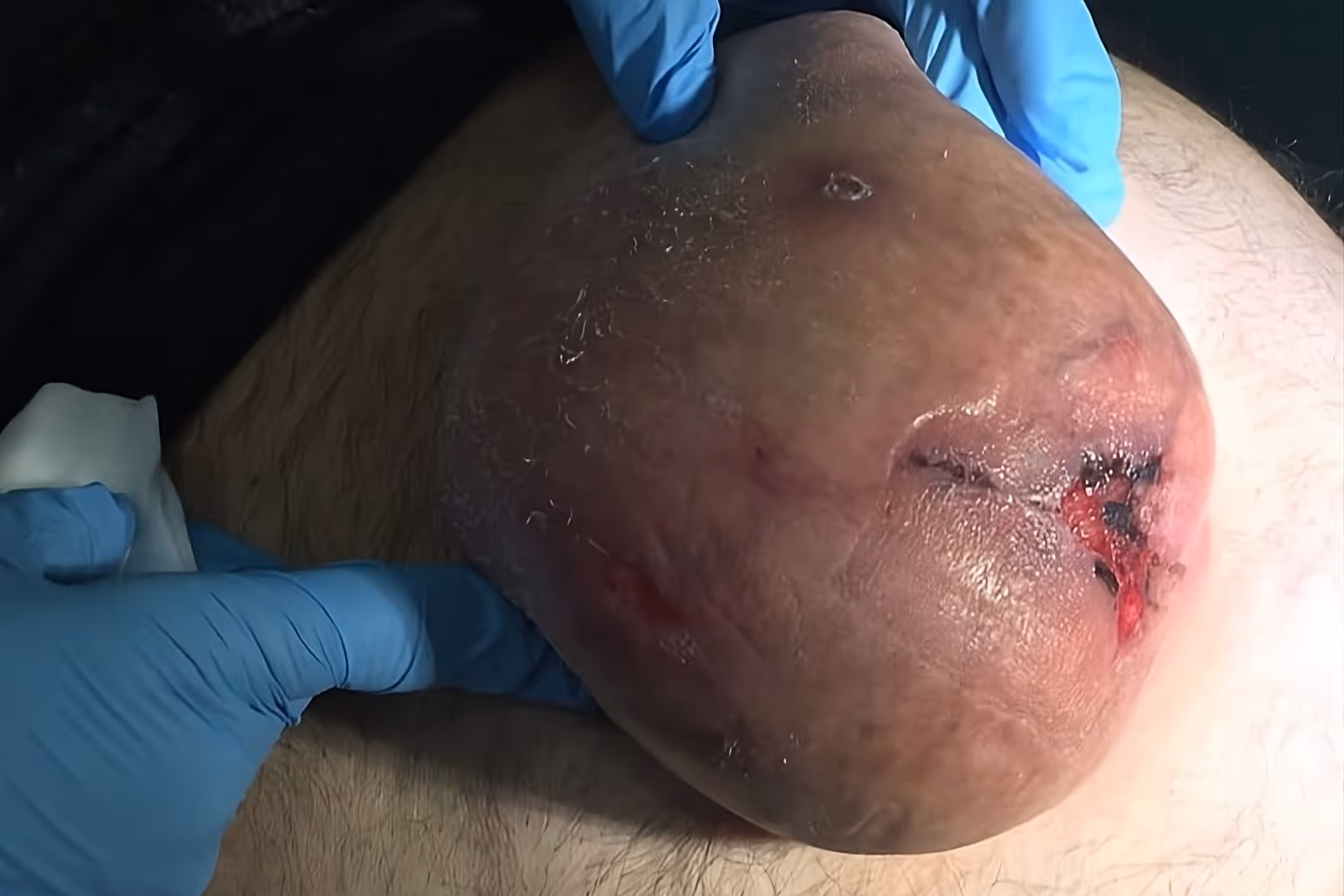 przepuklina pępkowa z owrzodzeniem