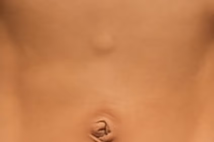 przepuklina kresy białej