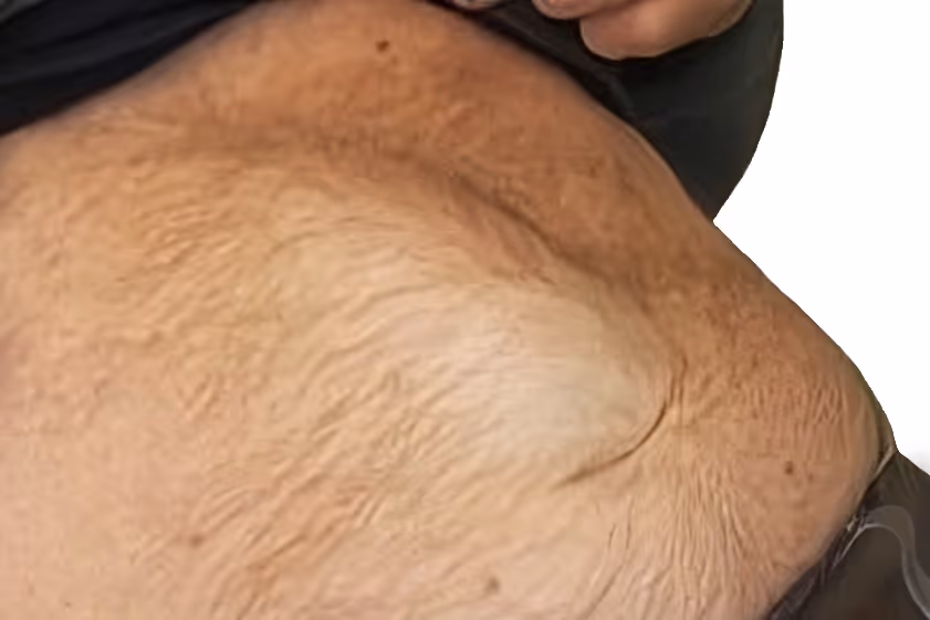 rozstep miesni prostych