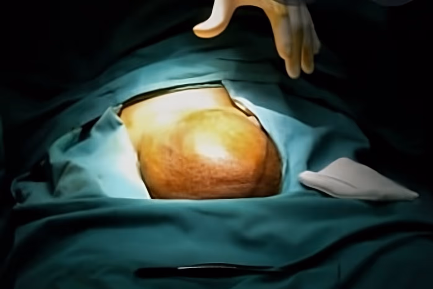 przepuklina mosznowa