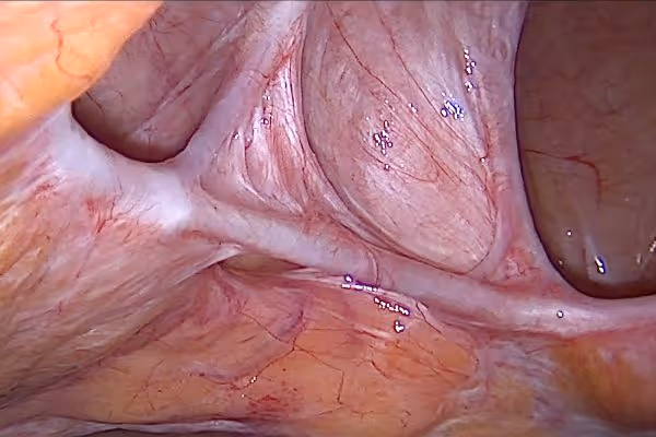 laparoskopowa operacja przepukliny brzusznej