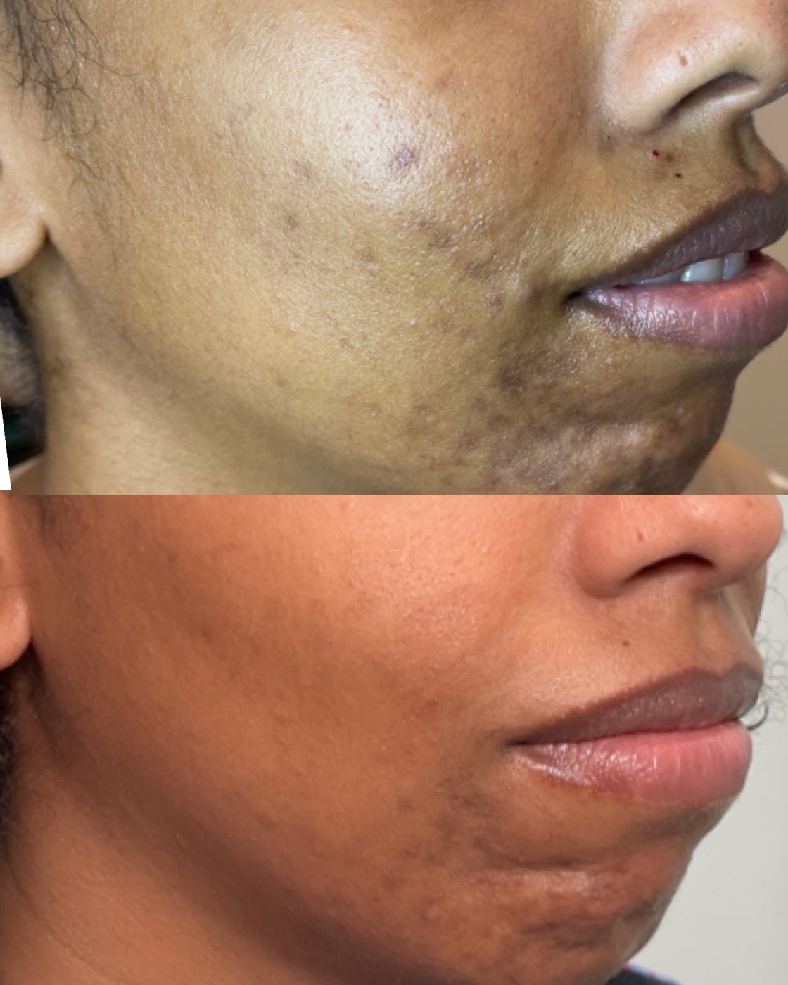 Before and after: acne and acne scars