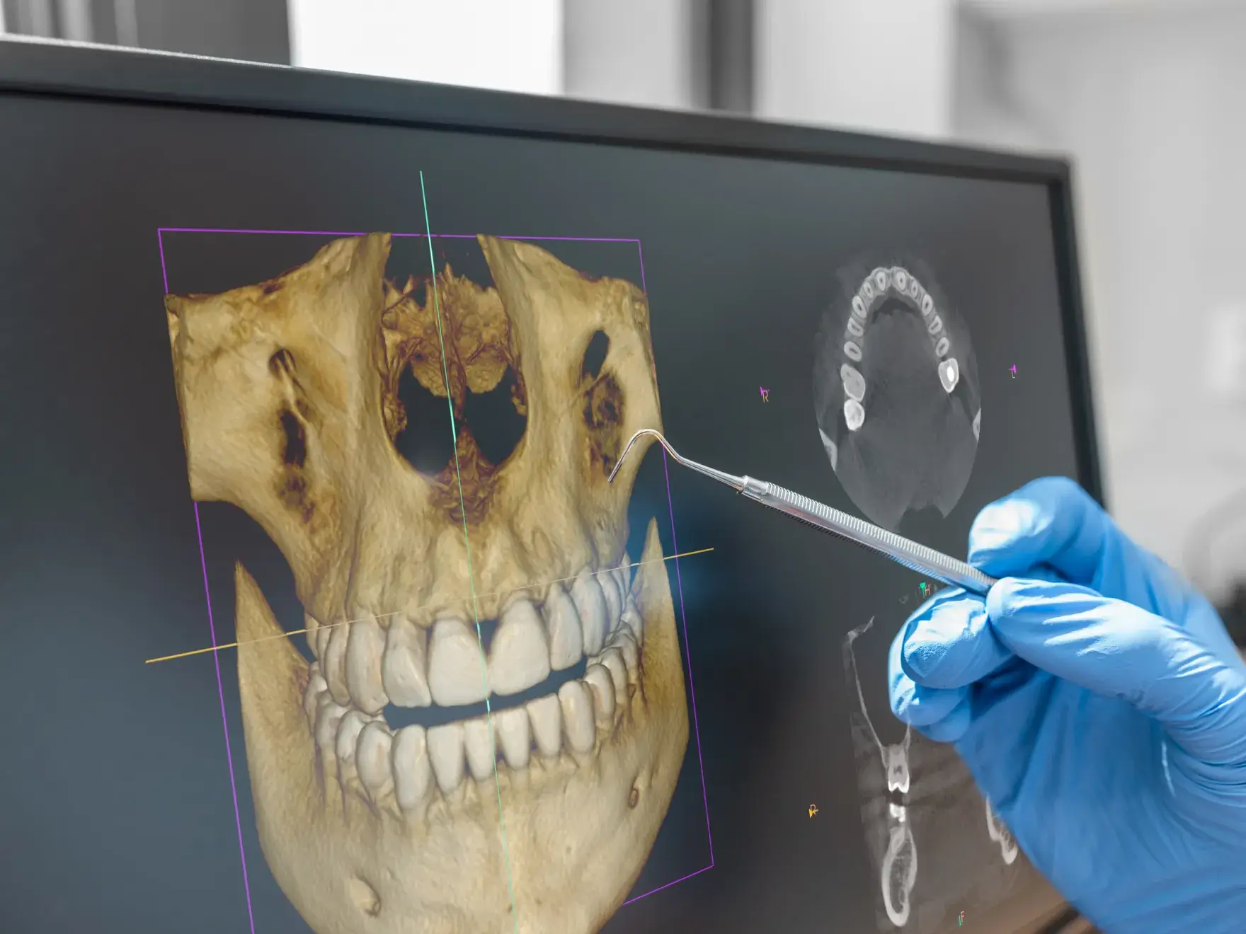 A gloved hand uses a dental tool on a 3D skull image displayed on a computer screen.