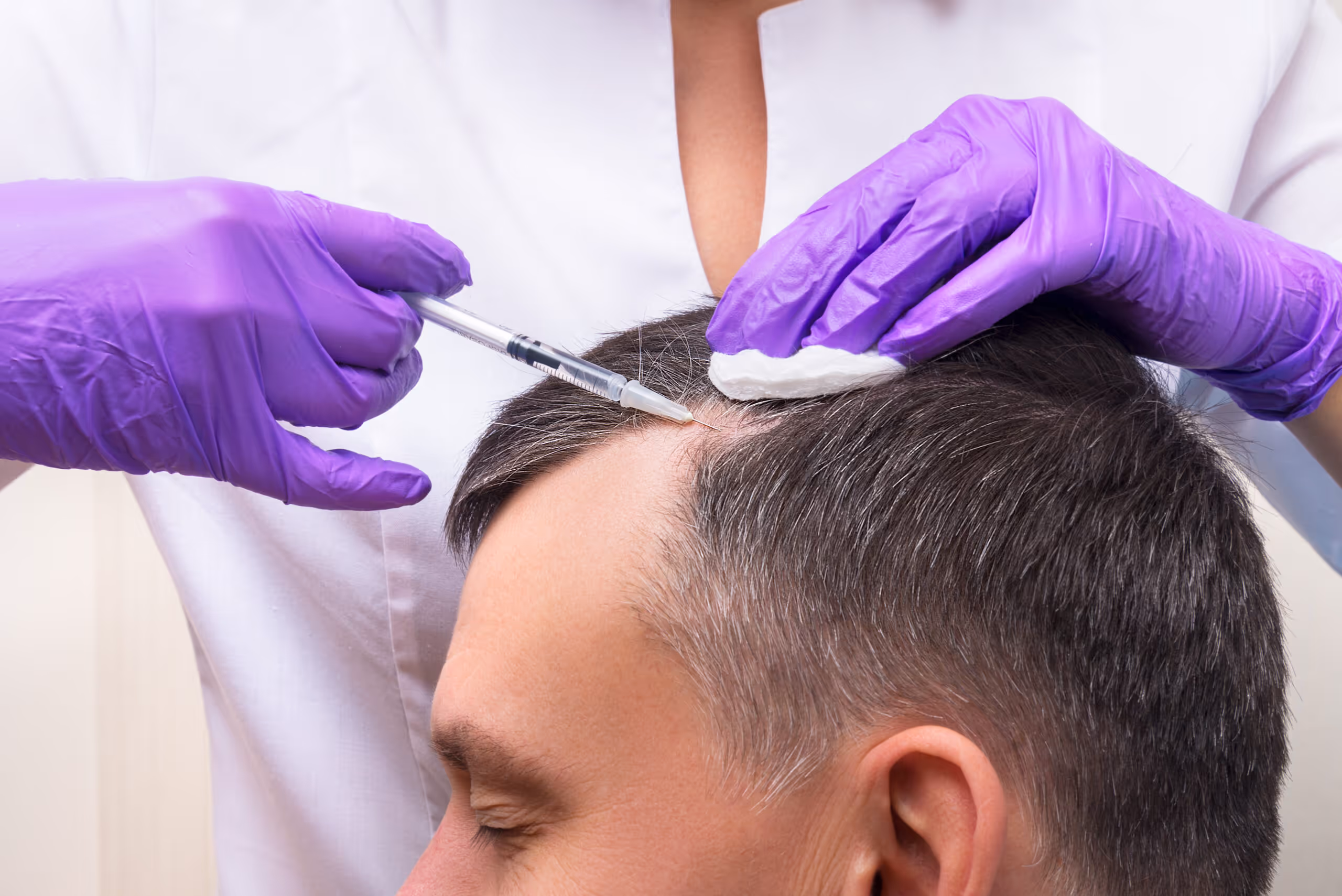 A healthcare professional injects treatment into a man's scalp while wearing purple gloves.