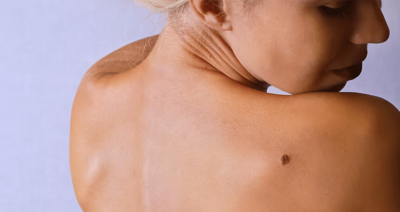 A woman looks at a dark mole on her upper back.
