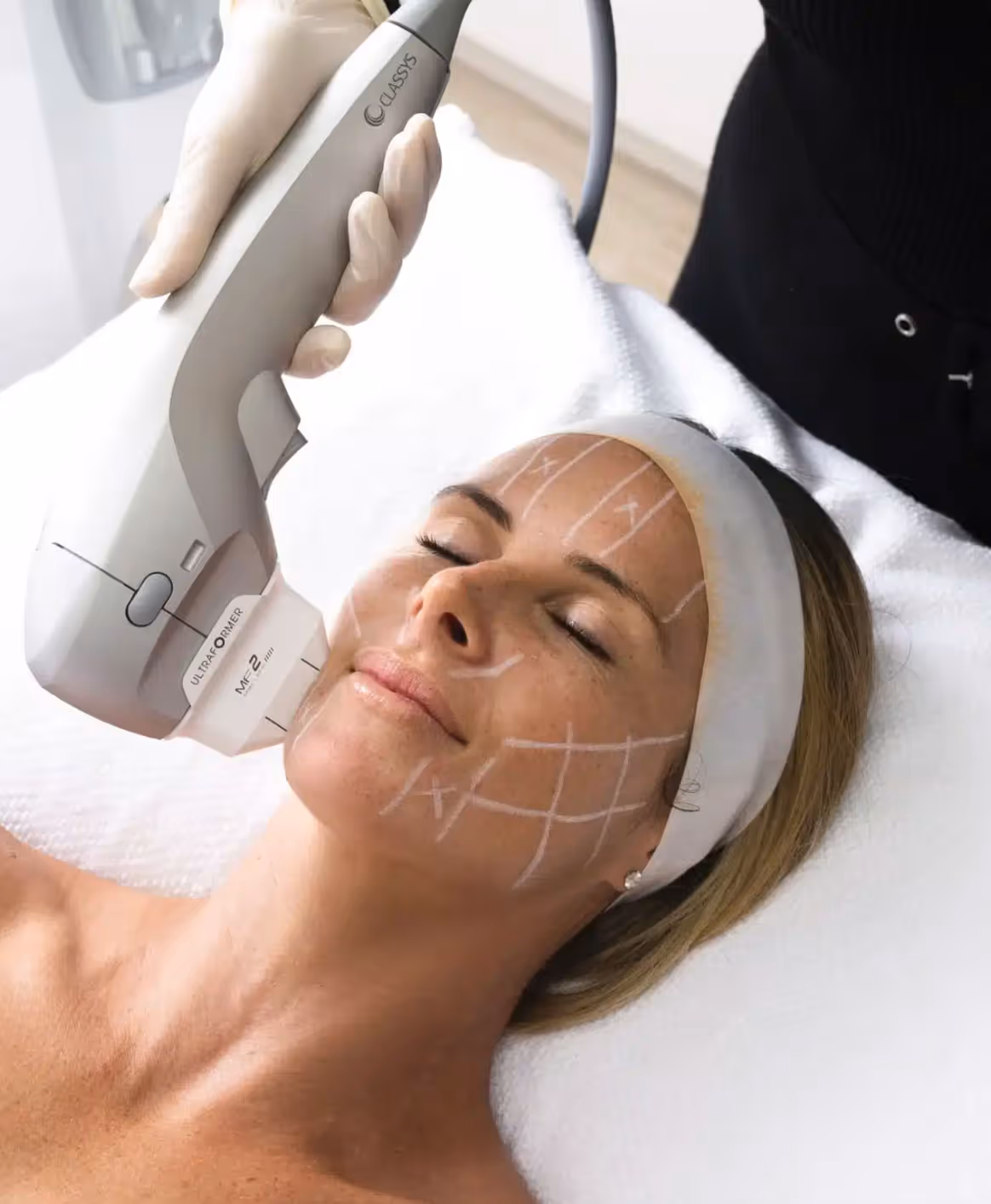 A person receives a facial treatment with a laser device, while markings are visible on their face.