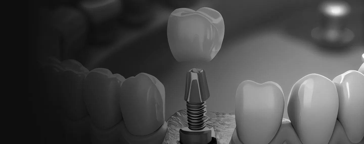 Schwarz-weiß-Darstellung eines Zahnimplantats mit Implantatkörper, Abutment und darauf sitzender Keramikkrone
