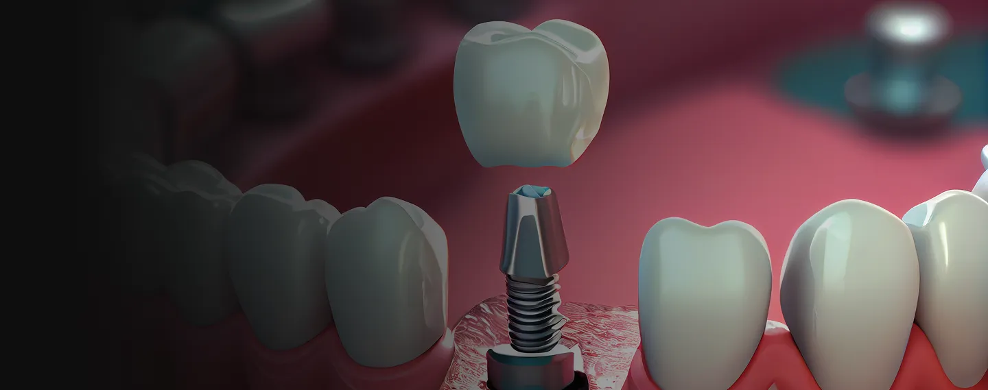 3D-Darstellung eines Zahnimplantats mit Implantatkörper, Abutment und darauf platzierter Keramikkrone