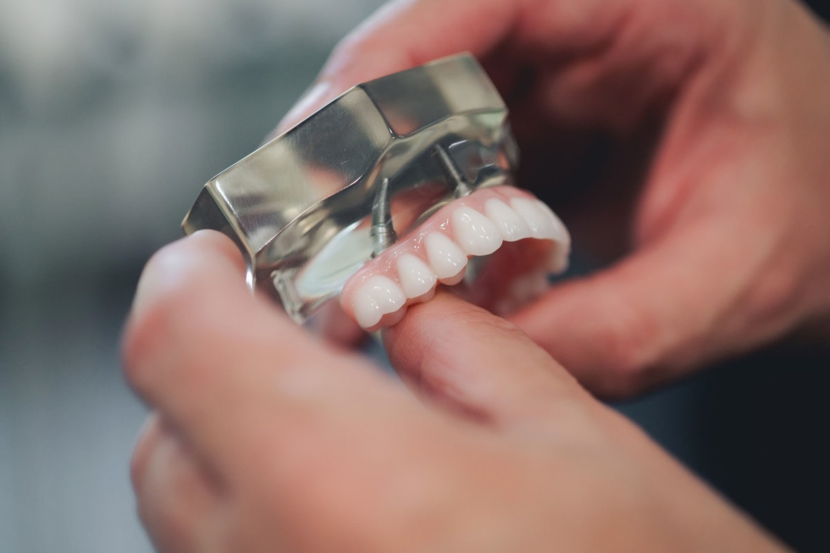 Close-up of hands holding a clear dental prosthetic model showing tooth structure and implant placement.