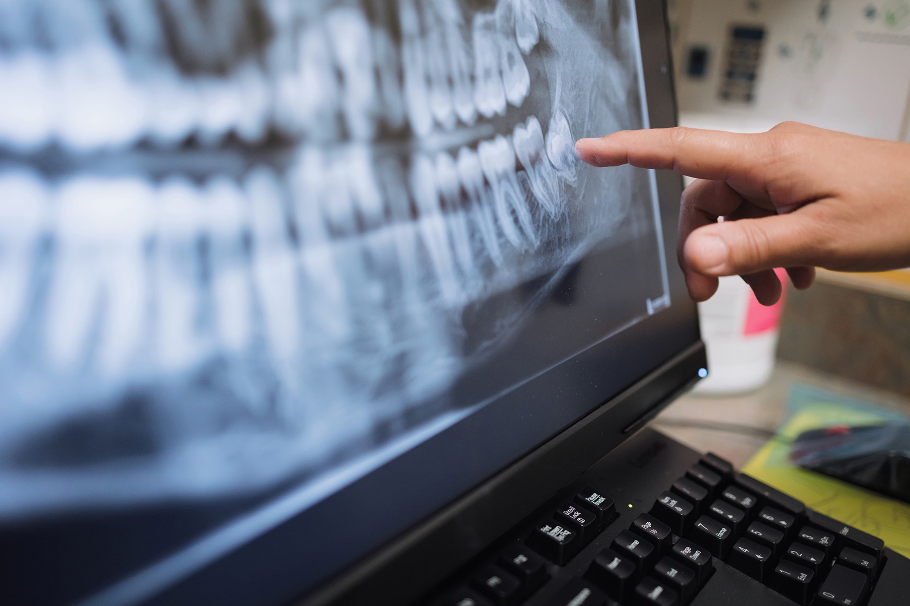 Close-up of a hand pointing at a dental X-ray image on a computer screen showing teeth and jaw structure.