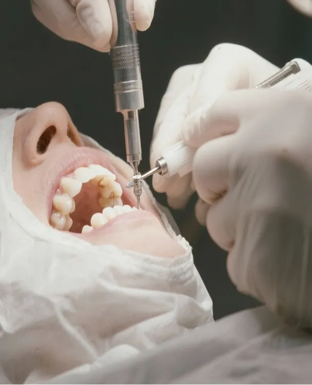 Dental Implants