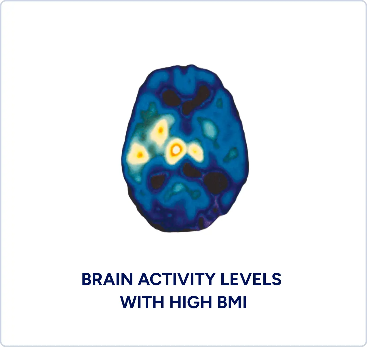 brain-activity-high-bmi