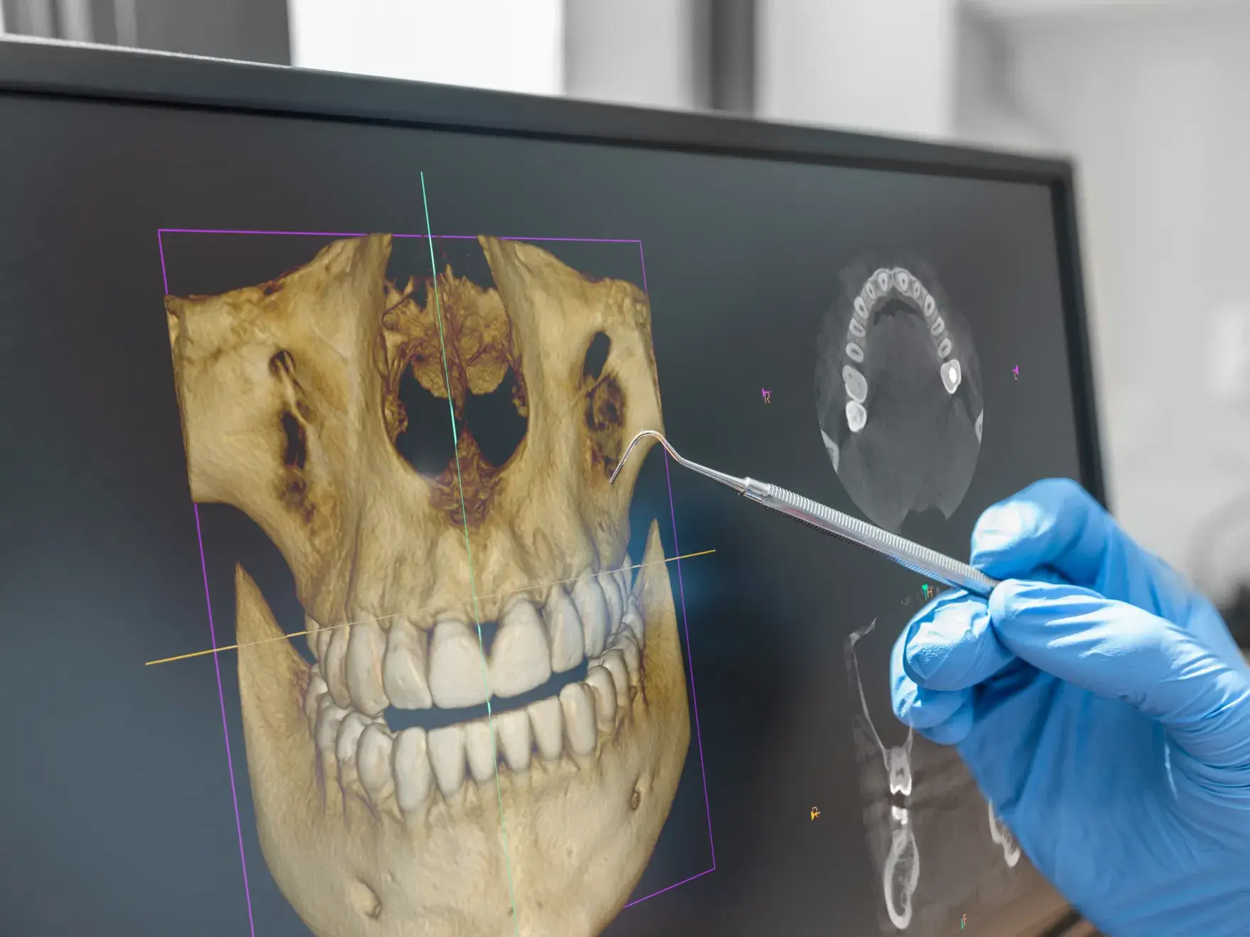Dental professional wearing blue gloves pointing to a 3D CT scan of a skull and teeth on a computer screen with a dental probe.