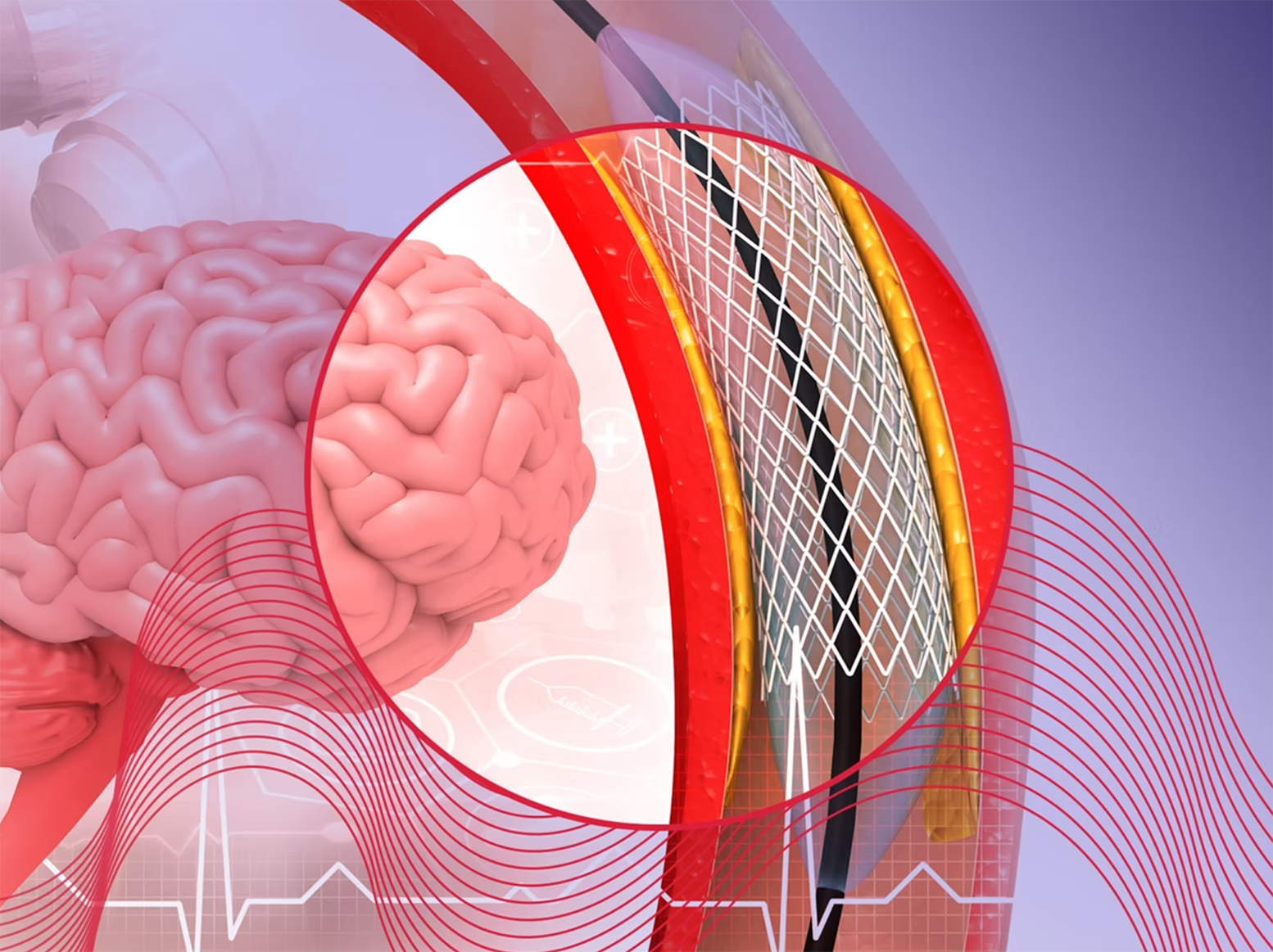 Medical illustration of a brain with a close-up showing a stent placed inside a blood vessel.