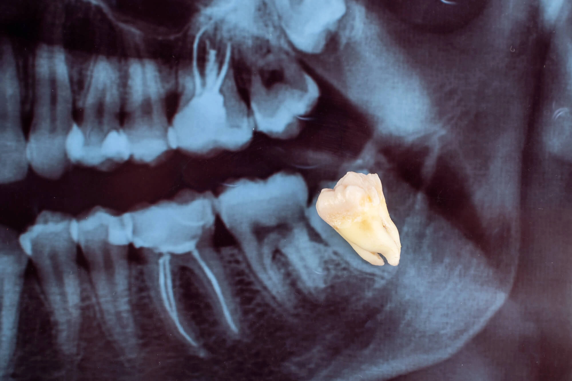 Xray of wisdom teeth removal reading pa