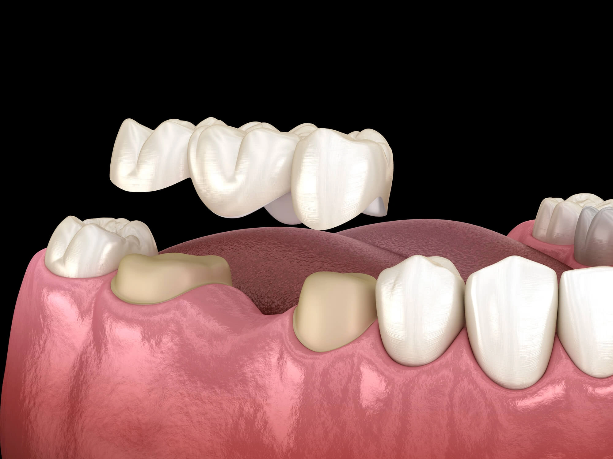 dental bridge reading pa