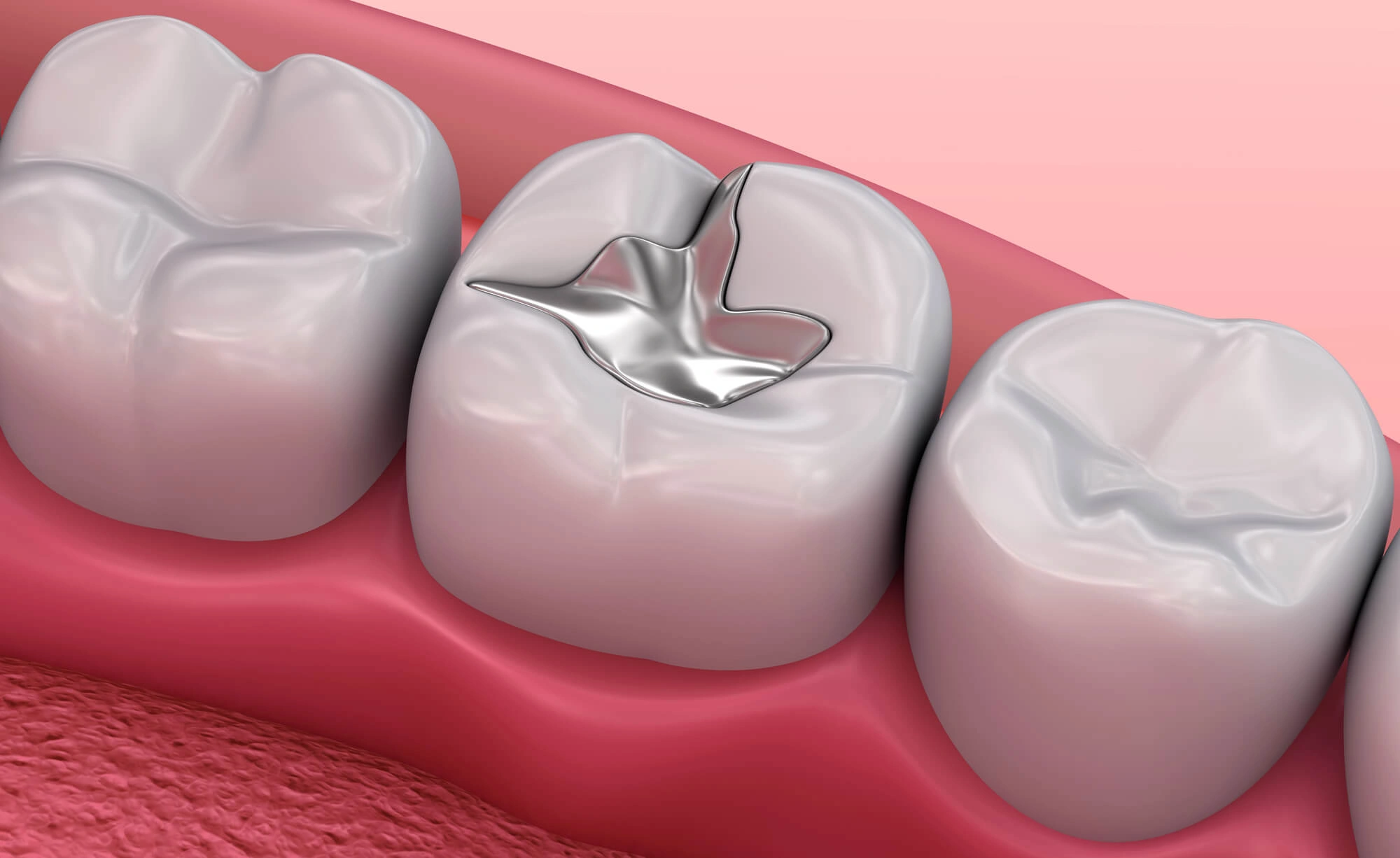 3D illustration of filling by reading dentists