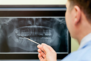 A digital dental X-ray image displayed on a screen in the treatment room