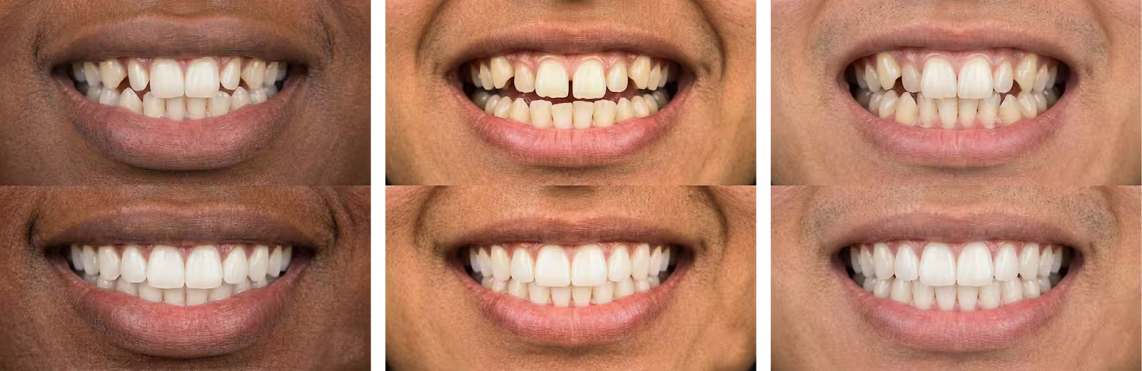 Adult patient holding Invisalign clear aligner tray at Century Dental East in Pine Beach NJ