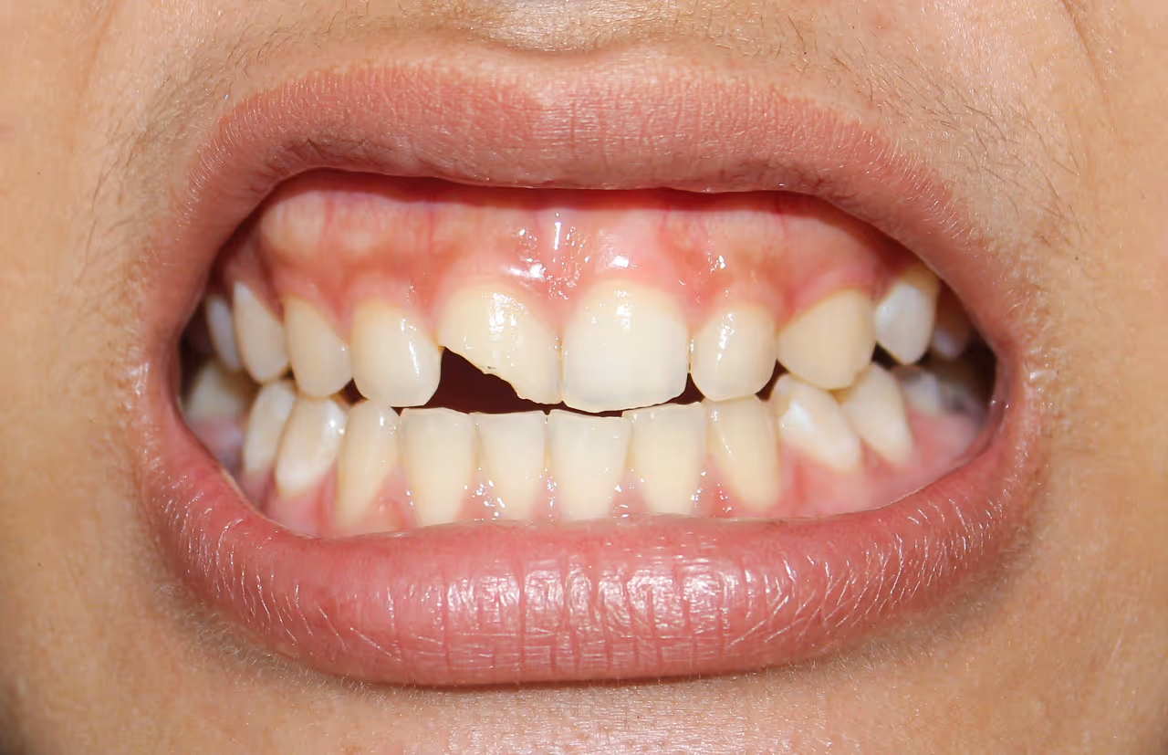 Chipped & Cracked Tooth Repair