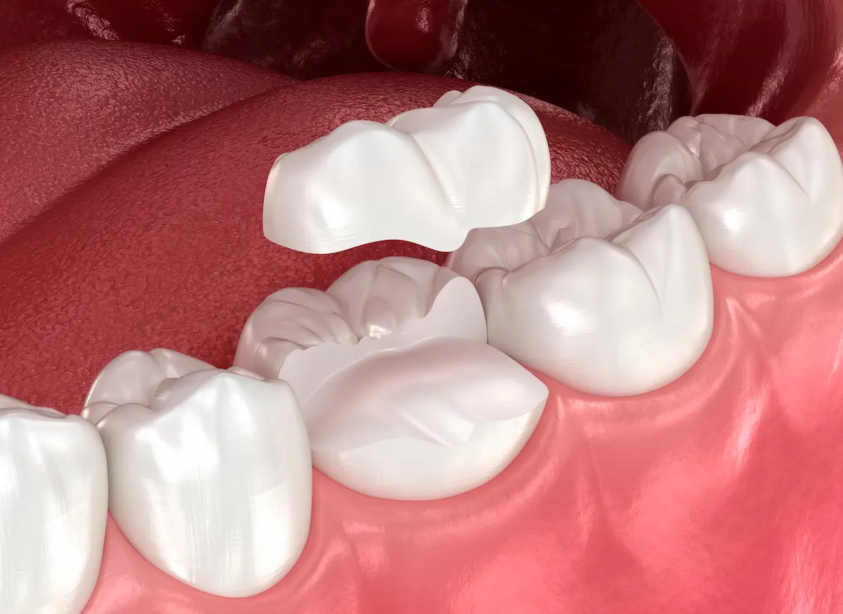Inlays & Onlays