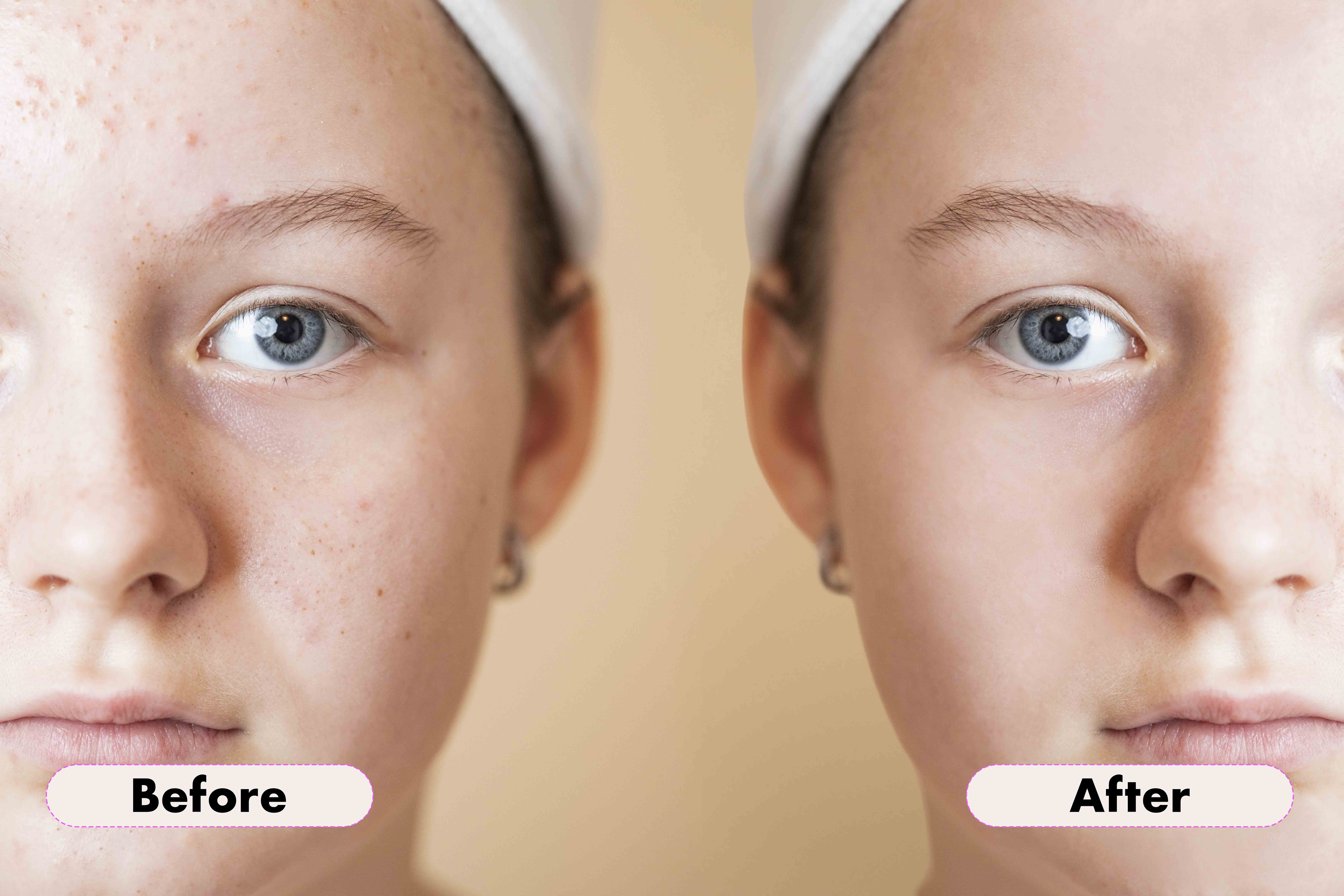 Close-up comparison of a young girl's face before and after skin blemish retouching, showing clearer skin on the right.
