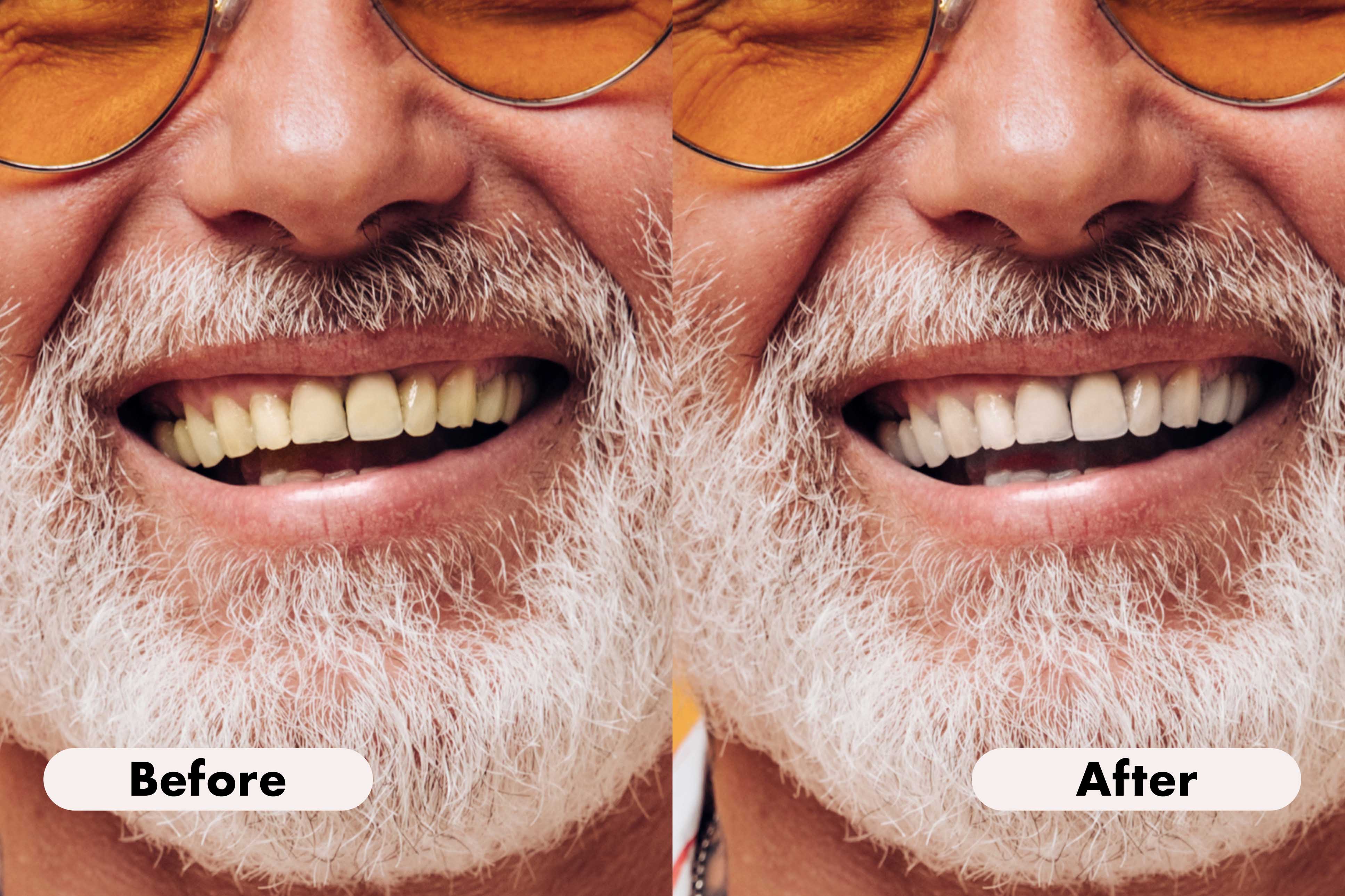 Side-by-side close-up of an older man's smile showing yellowed teeth before and whiter teeth after dental treatment.