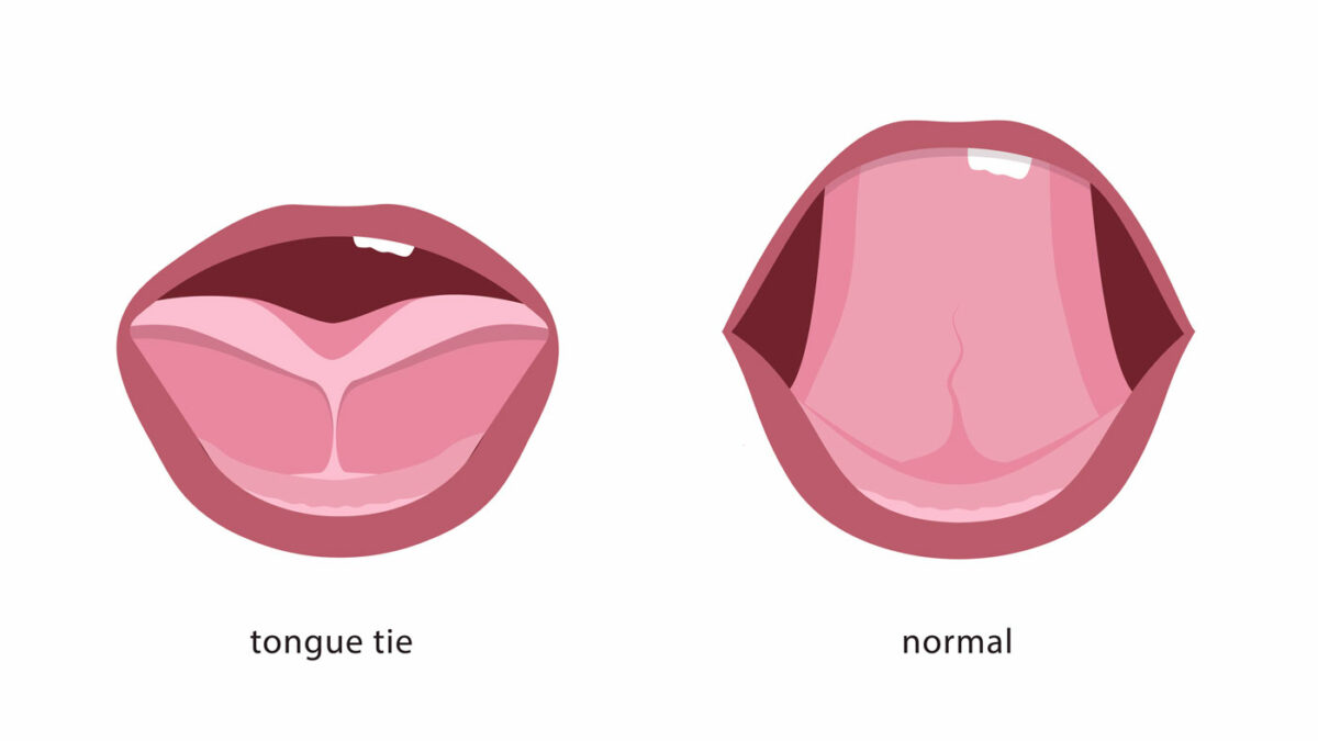 tongue-tie illustration