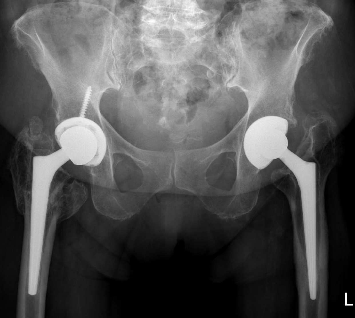 Scan of a prosthetic joint infection example