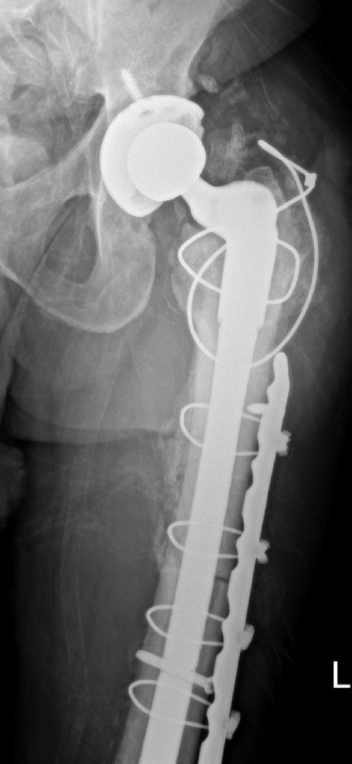 Scan of an example of a fracture related infection