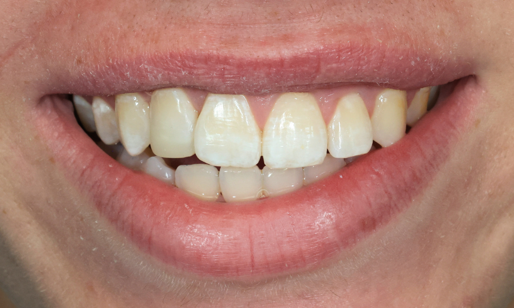 Close-up of a person’s smile showing slightly uneven upper front teeth with white spots and natural lip texture.