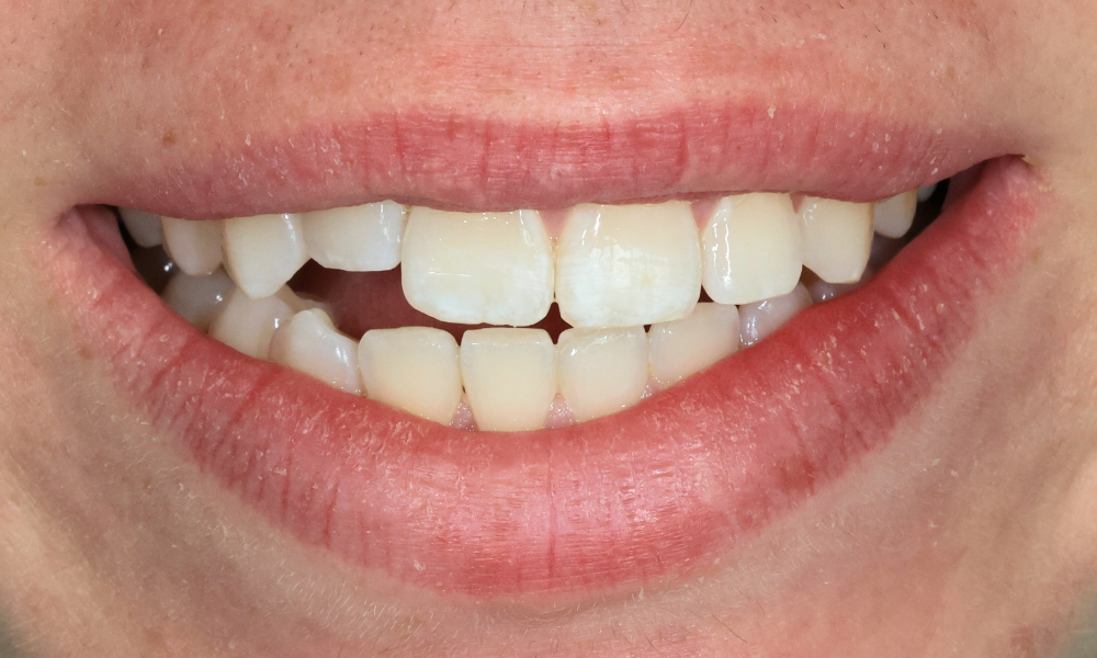 Close-up of a smile showing slightly crooked and discolored upper front teeth with gaps.