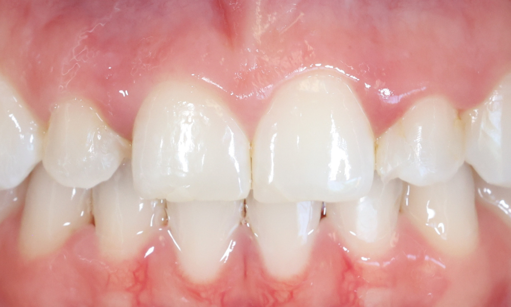 Close-up of upper front teeth with slight gaps and irregular alignment.