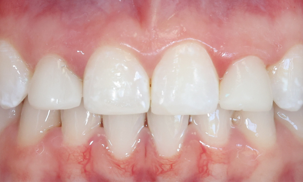 Close-up of front lower teeth with pink gums and visible dental bonding on some teeth.